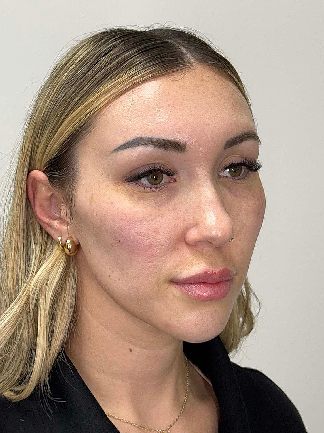 Facial Balancing Before & After
