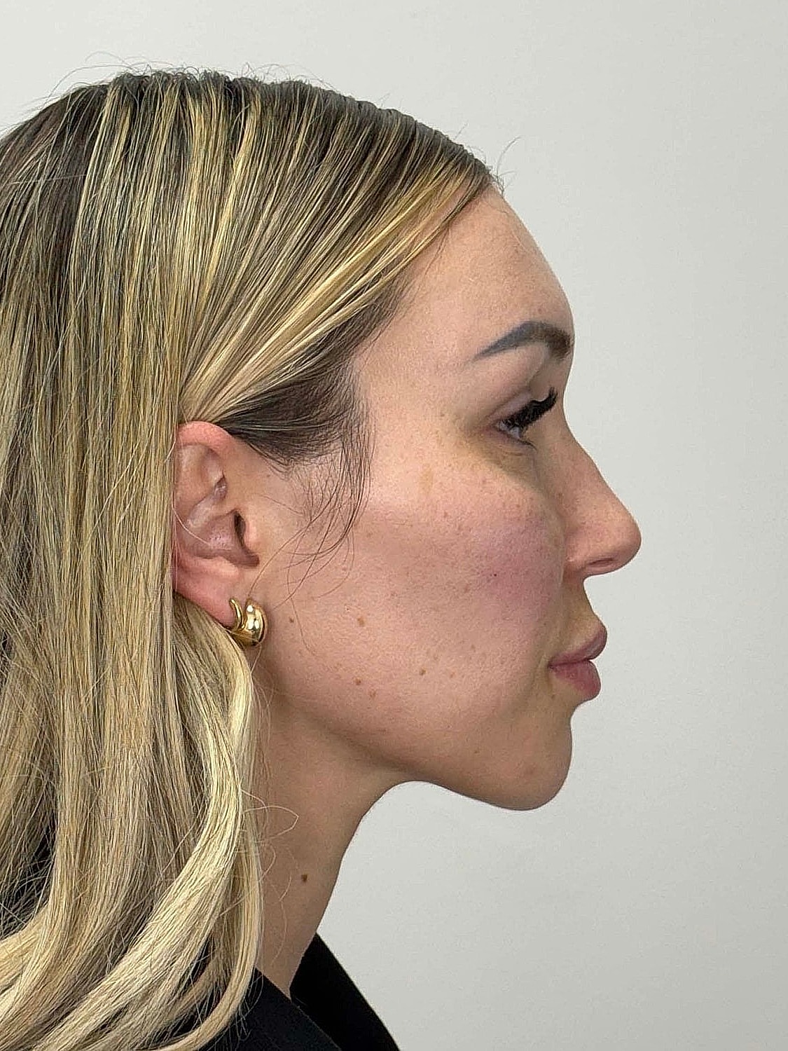 Facial Balancing Before & After