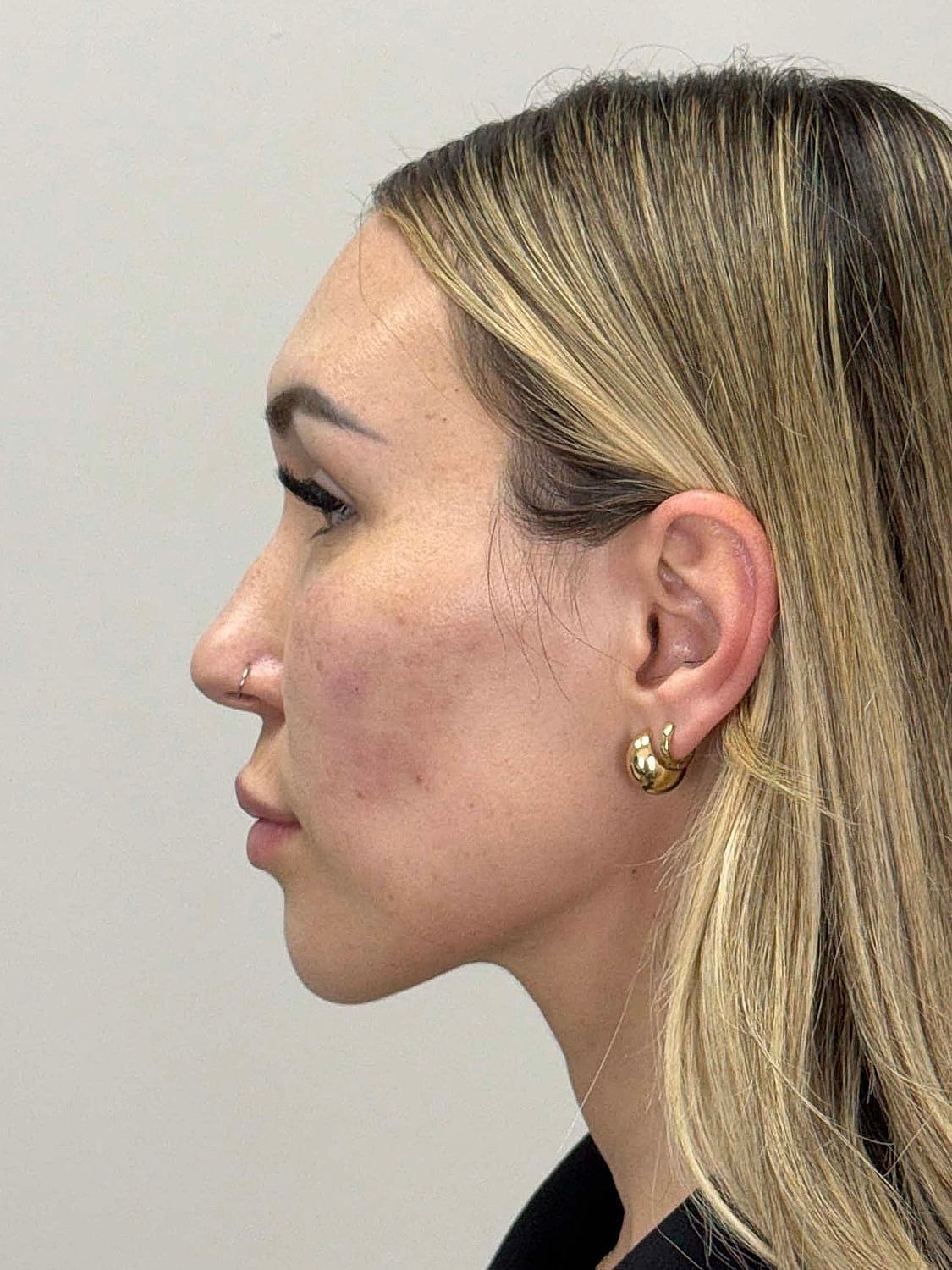Facial Balancing Before & After