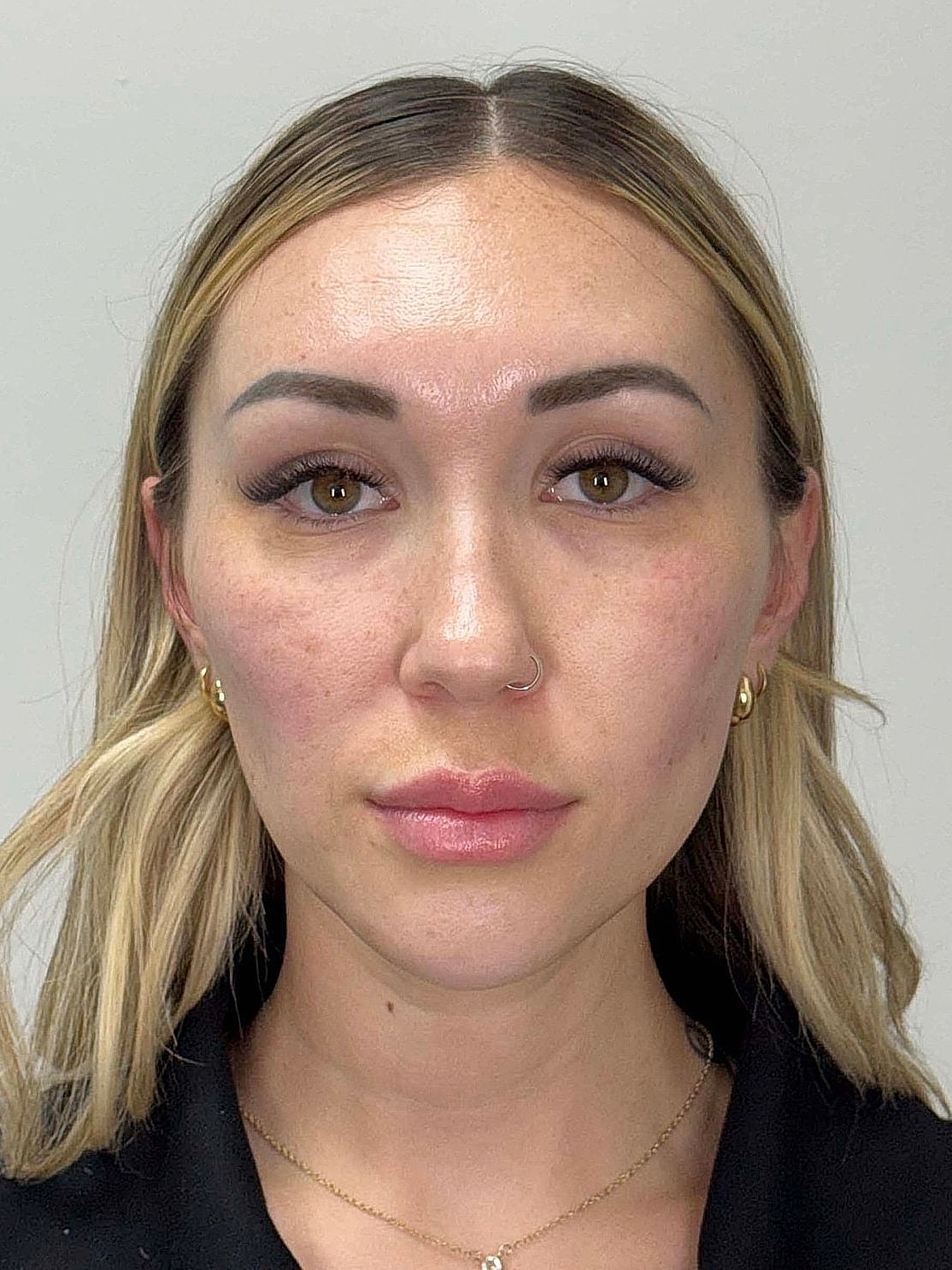 Facial Balancing Before & After