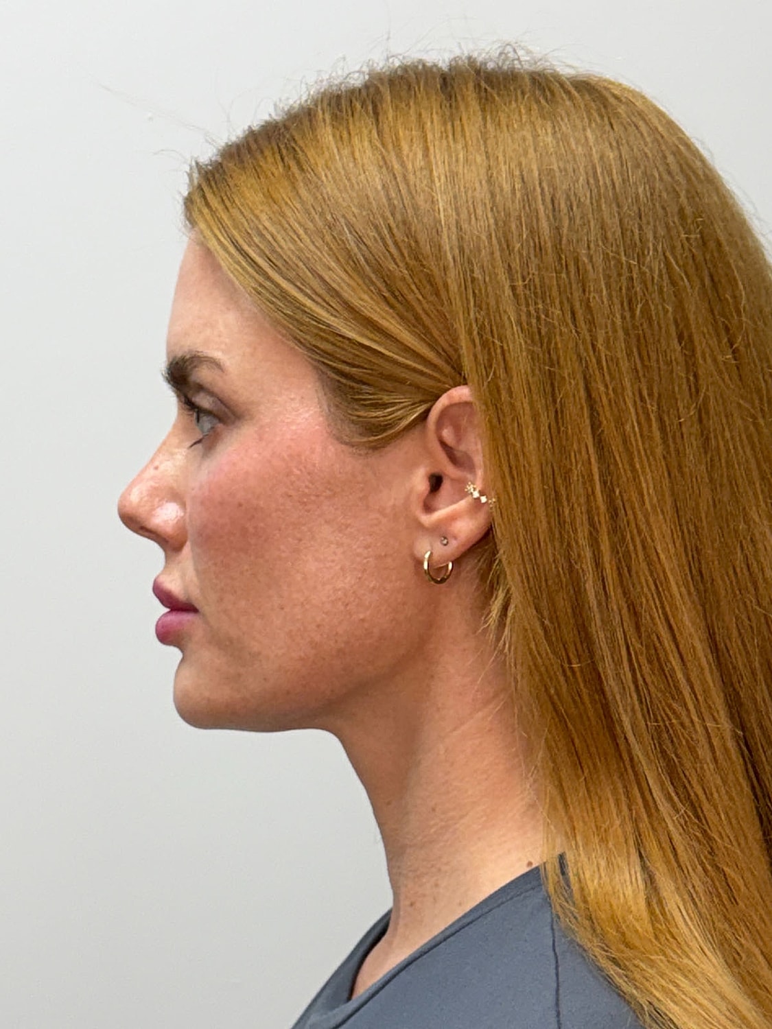 Facial Balancing Before & After