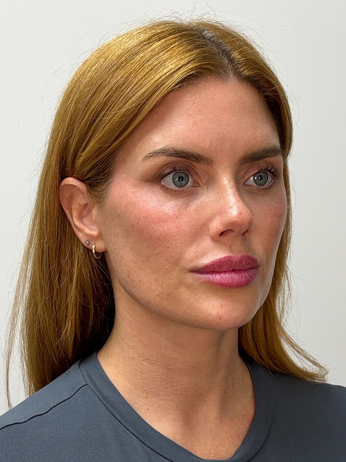 Facial Balancing Before & After