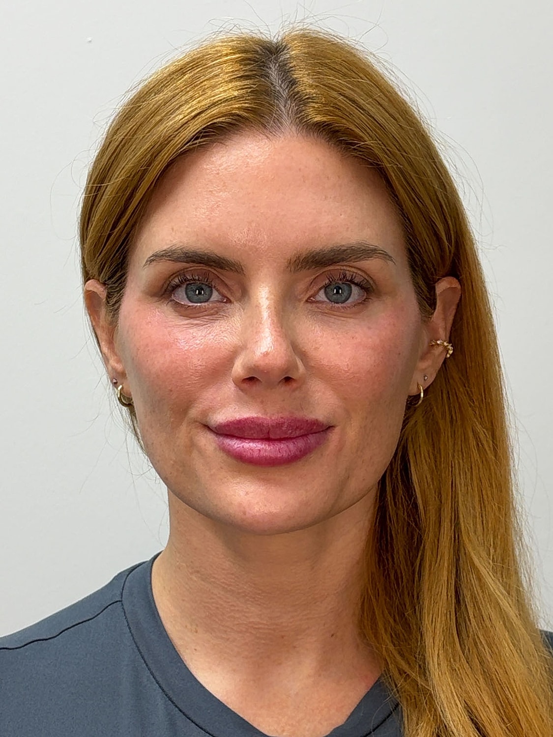 Facial Balancing Before & After
