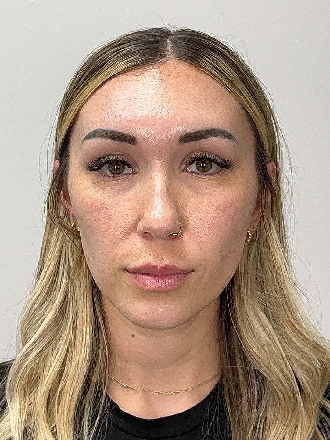 Facial Balancing Before & After