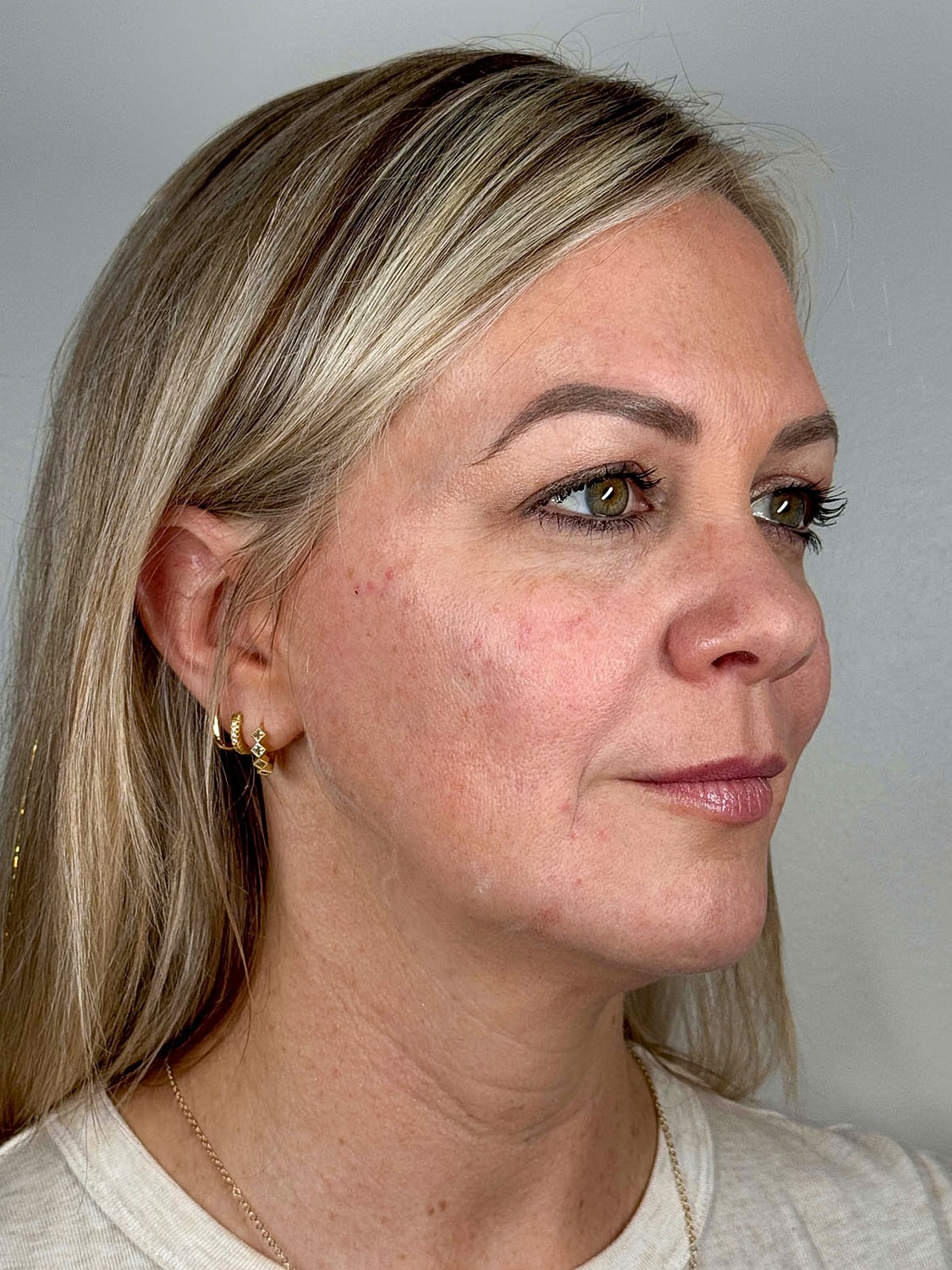 Facial Balancing Before & After