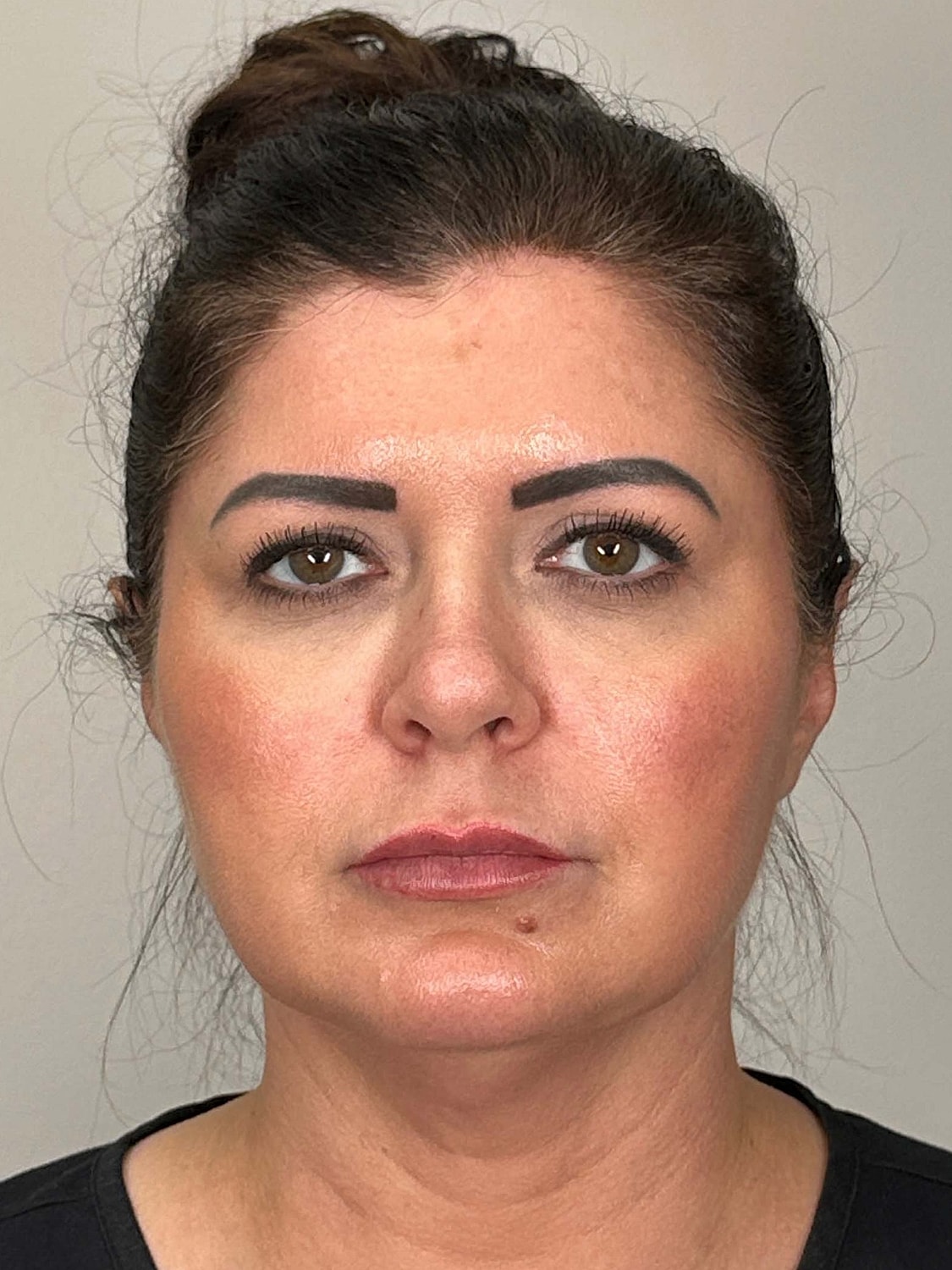 Facial Balancing Before & After