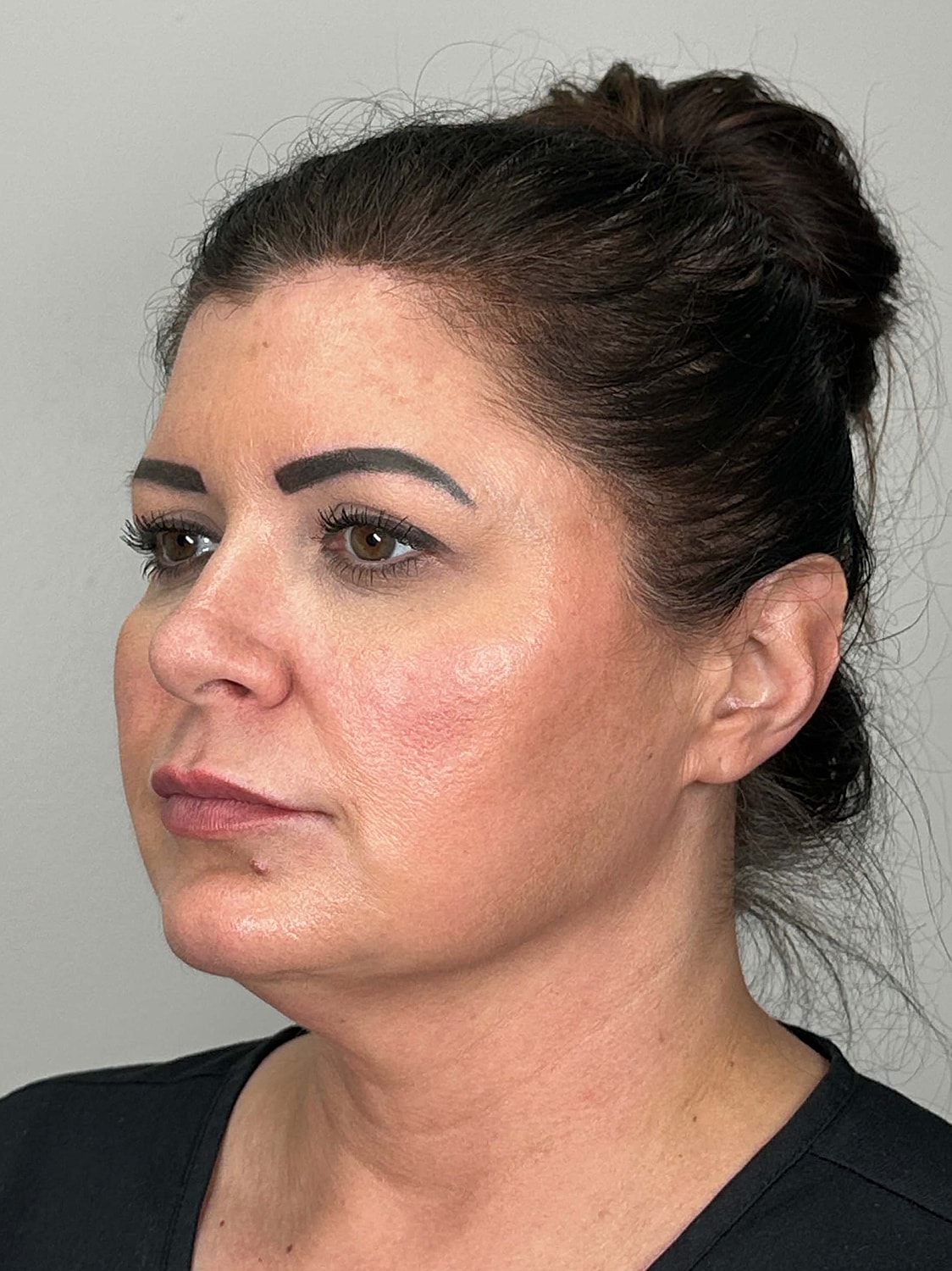 Facial Balancing Before & After