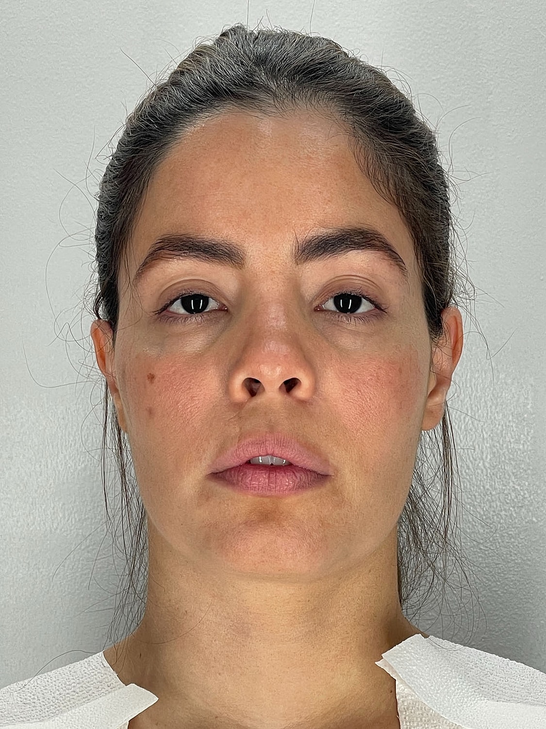 Facial Balancing Before & After