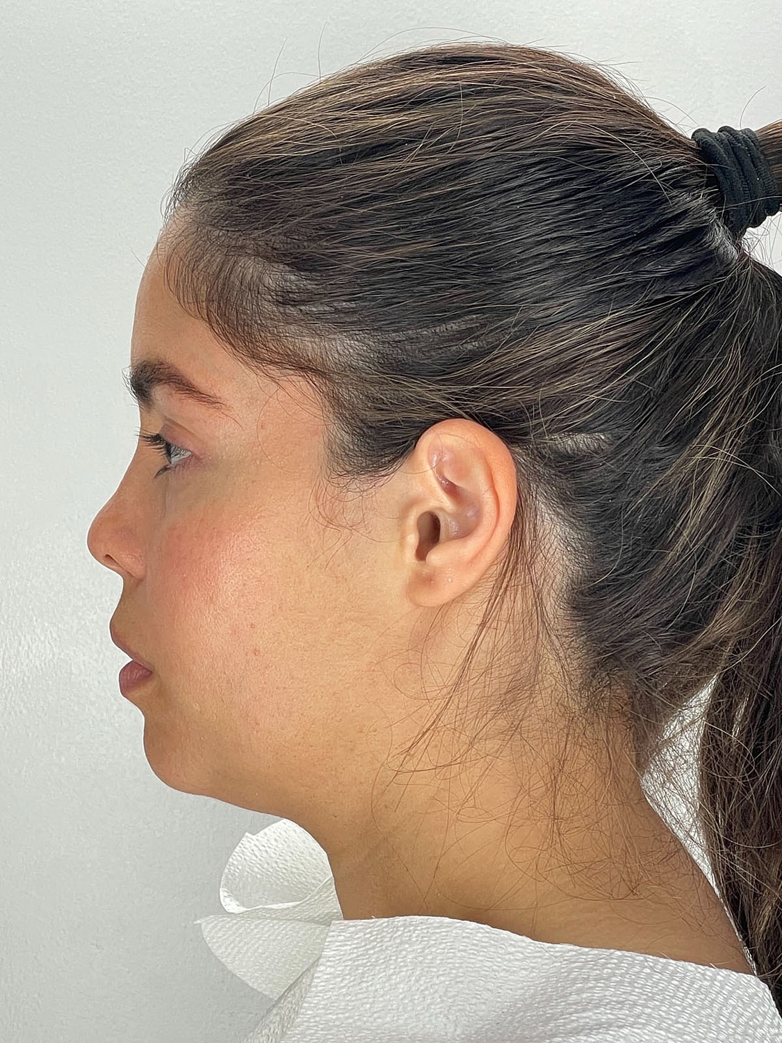 Facial Balancing Before & After