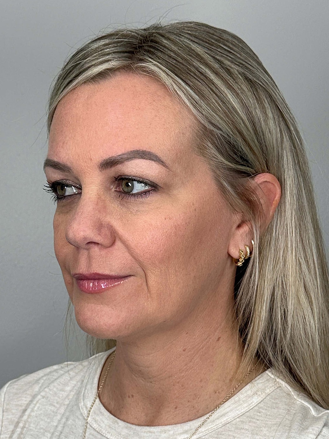 Facial Balancing Before & After