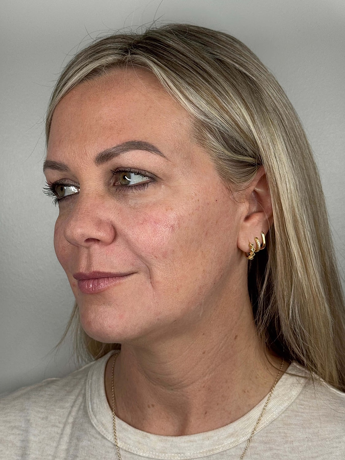Facial Balancing Before & After