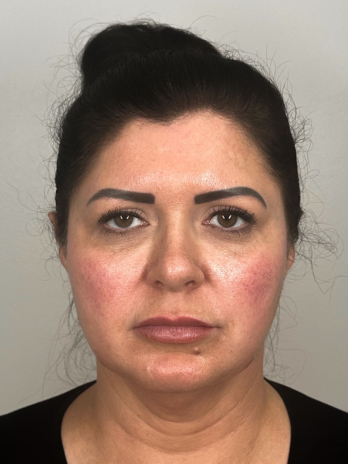 Facial Balancing Before & After