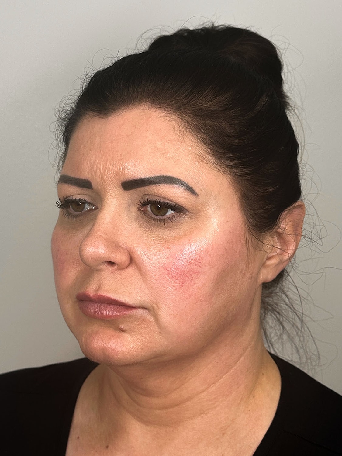 Facial Balancing Before & After