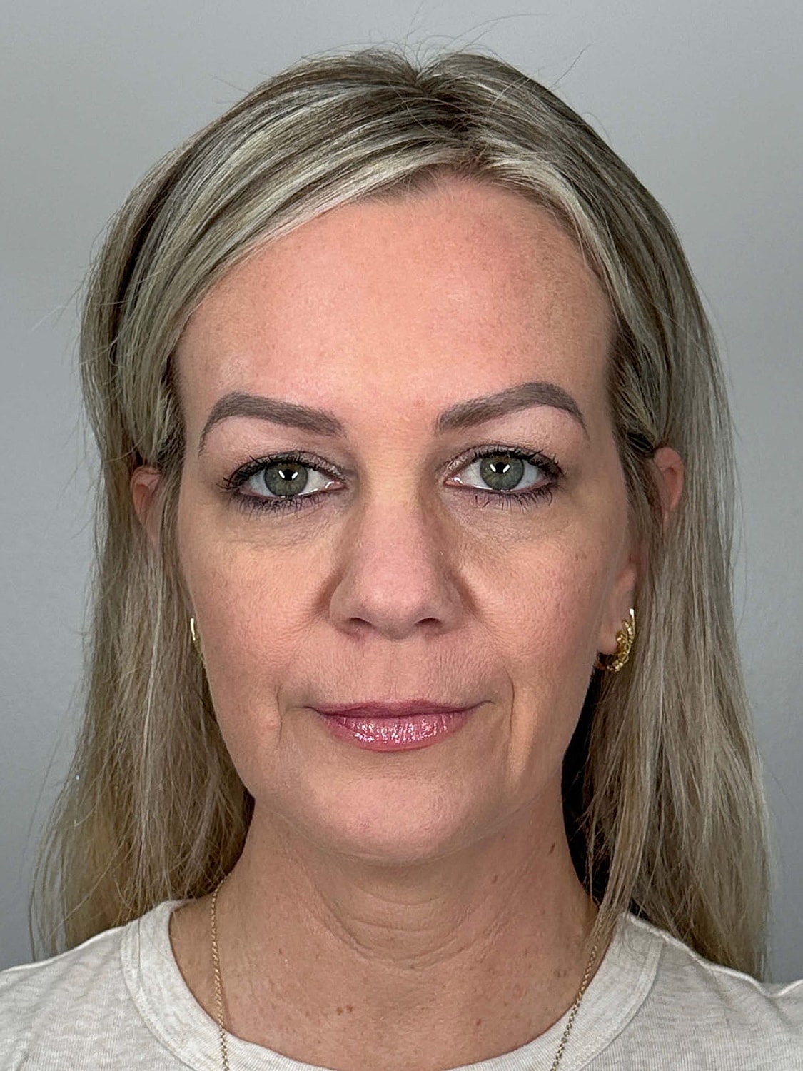 Facial Balancing Before & After