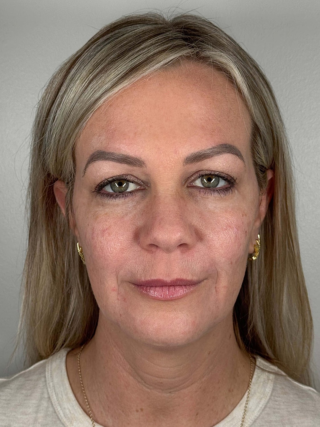 Facial Balancing Before & After