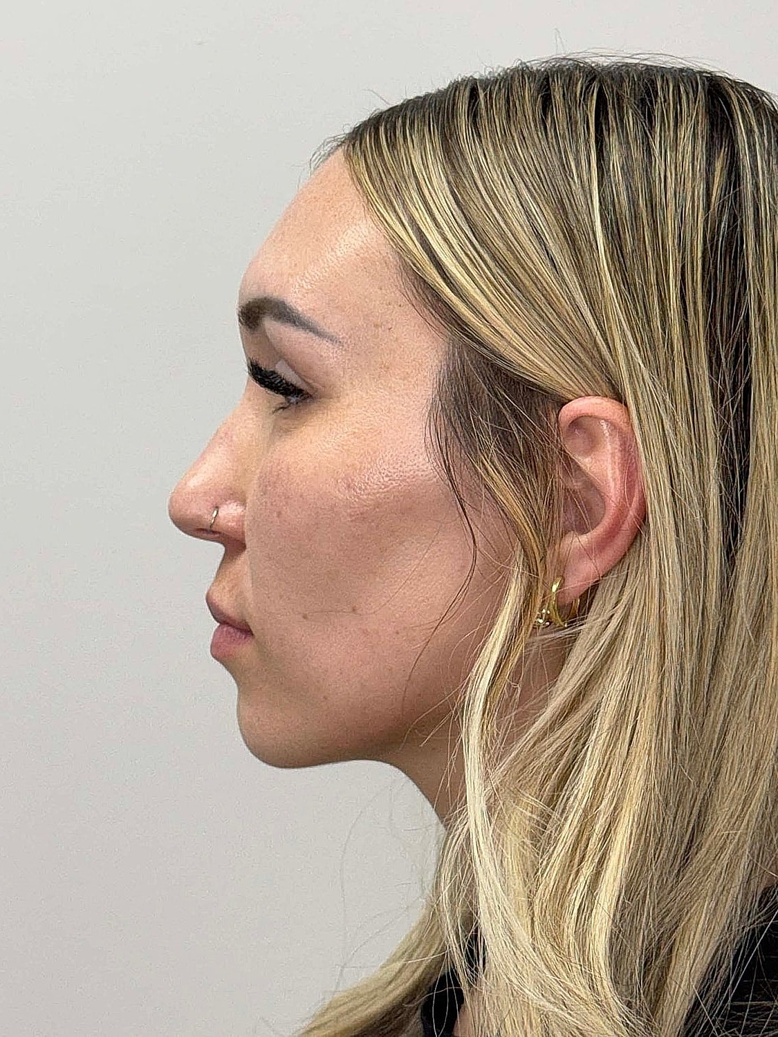 Facial Balancing Before & After