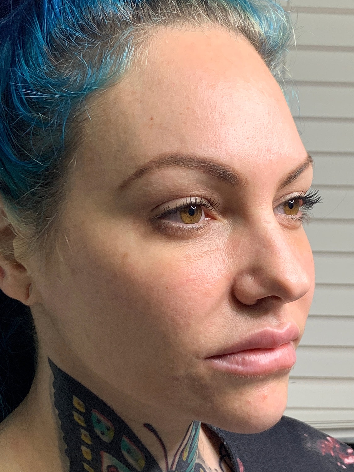 Facial Balancing Before & After