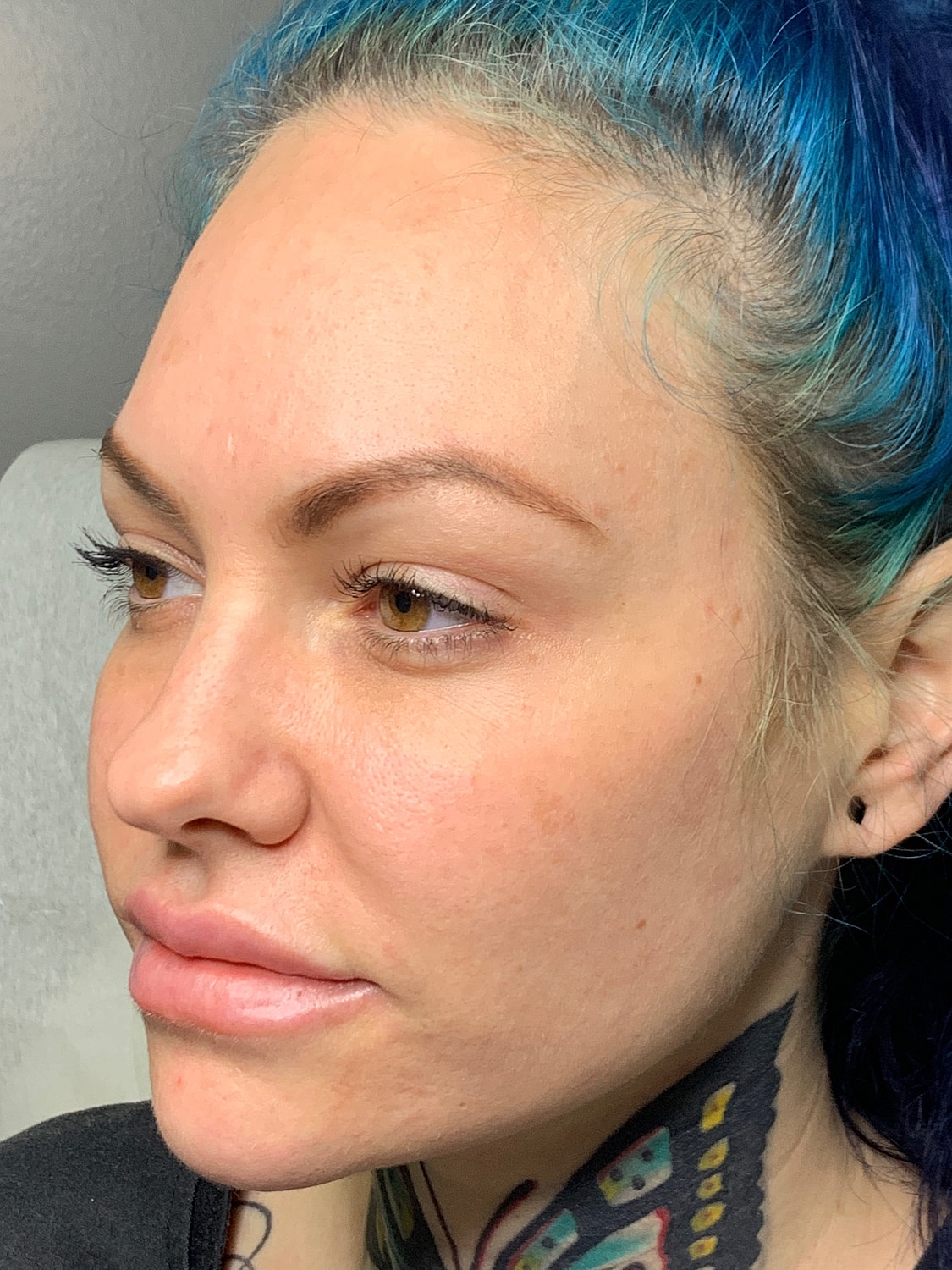 Facial Balancing Before & After