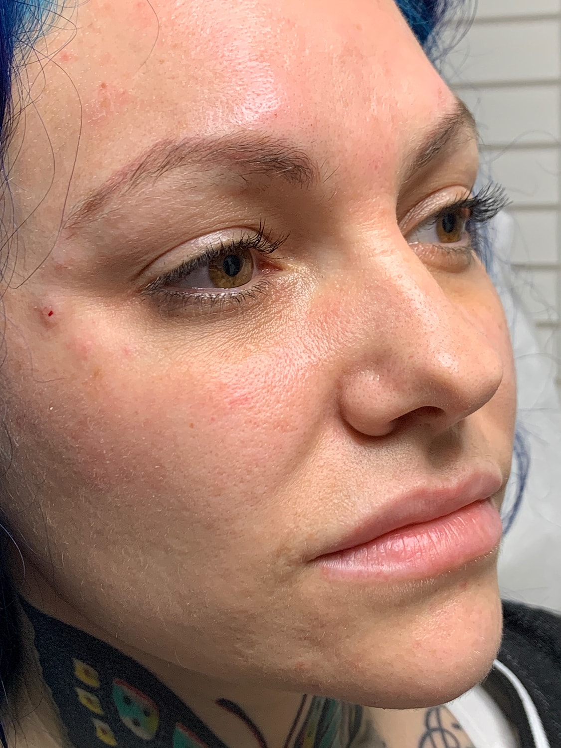 Facial Balancing Before & After