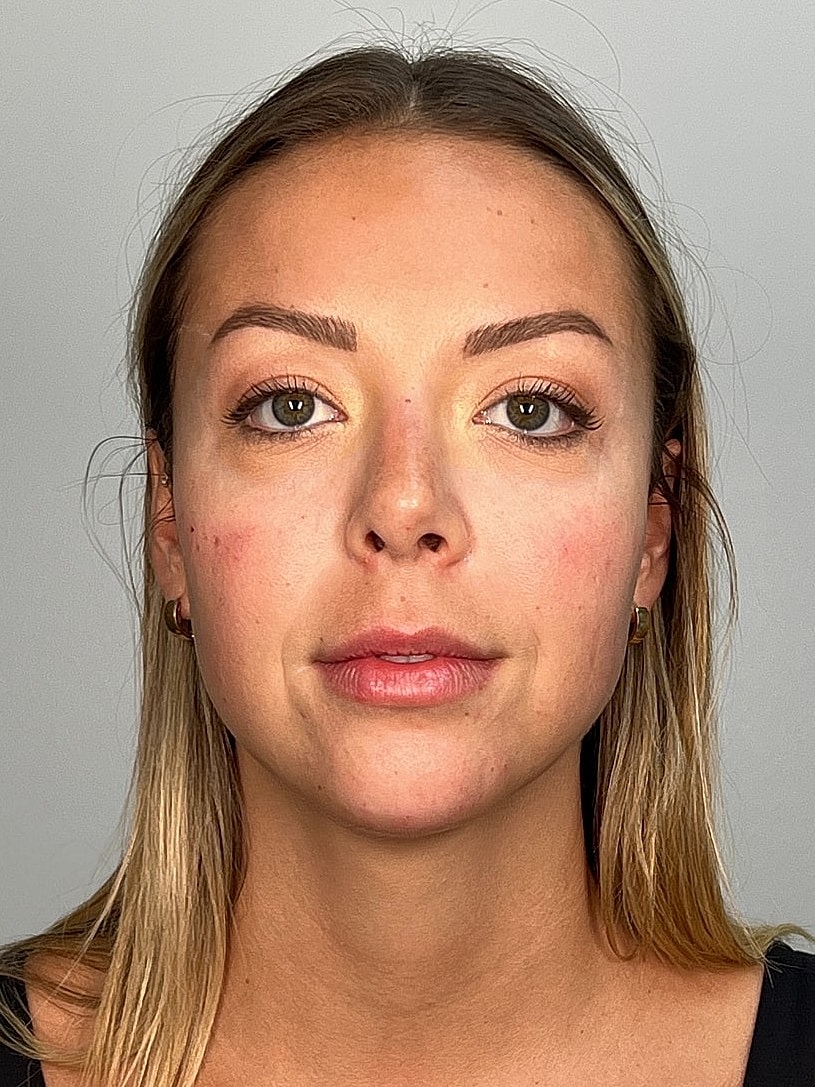 Facial Balancing Before & After