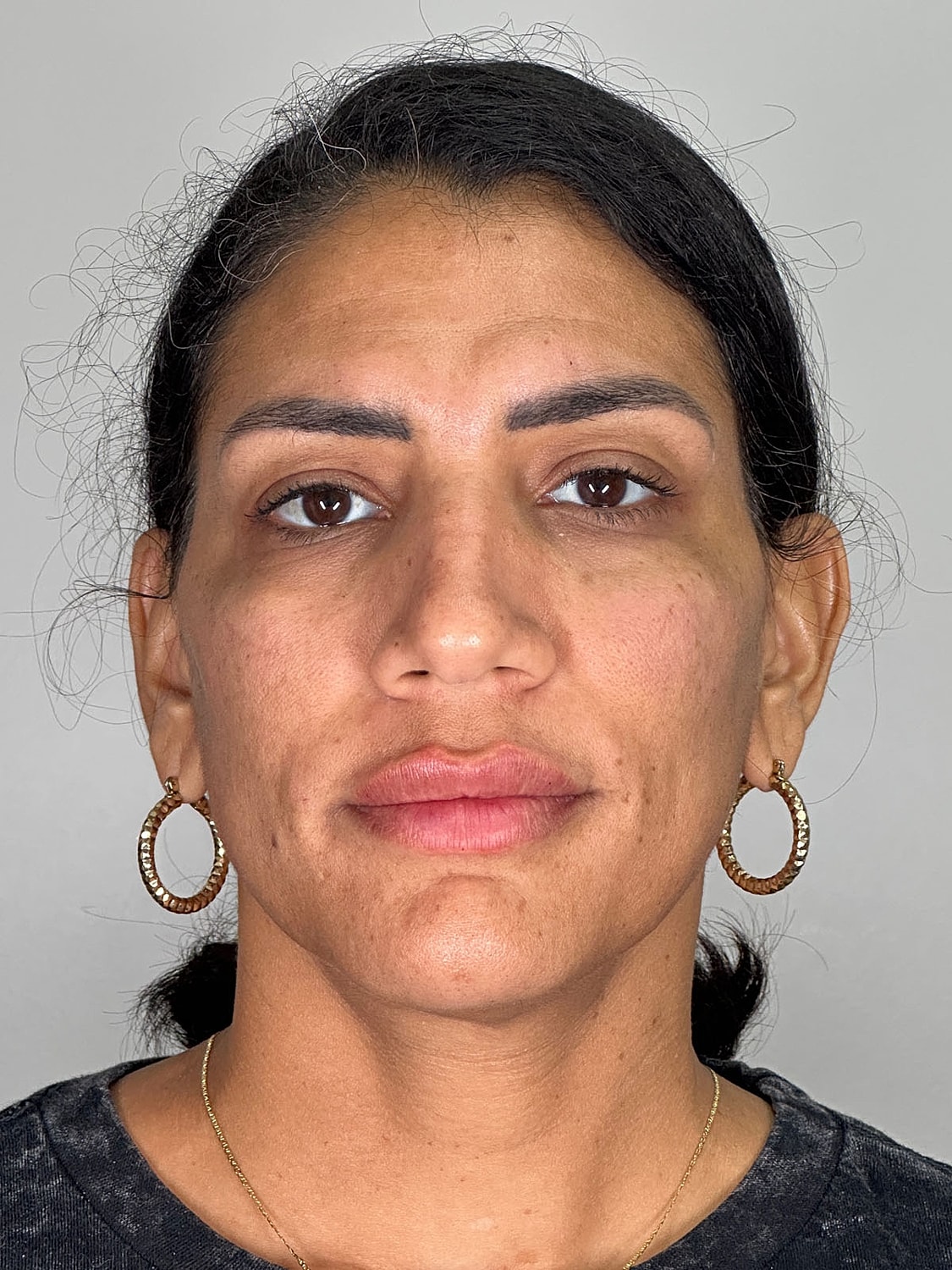 Facial Balancing Before & After