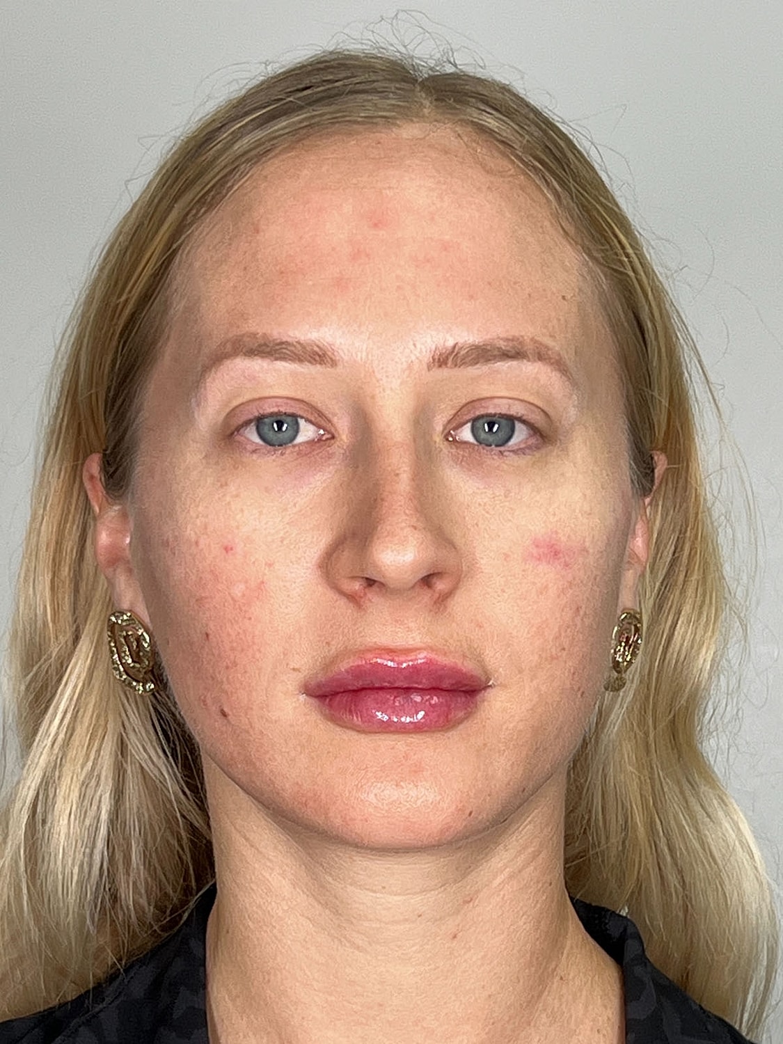 Facial Balancing Before & After