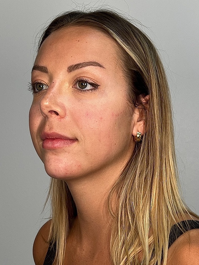 Facial Balancing Before & After