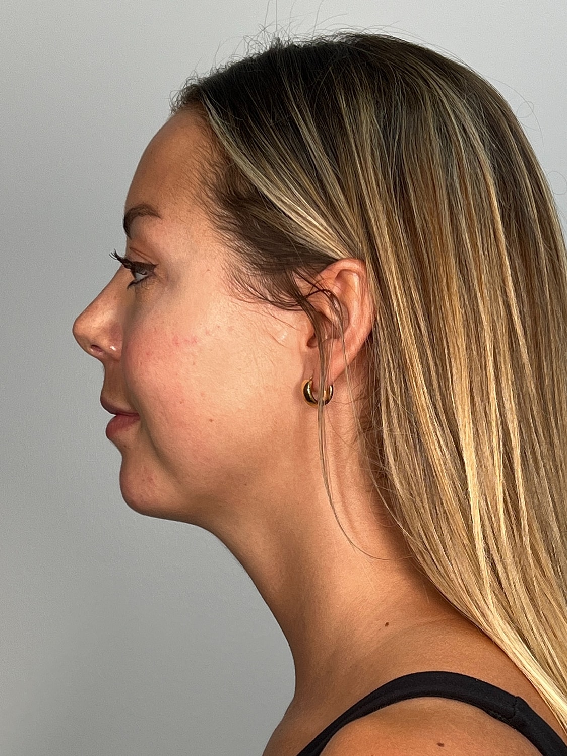 Facial Balancing Before & After