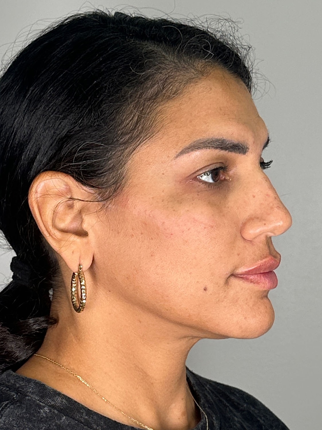 Facial Balancing Before & After