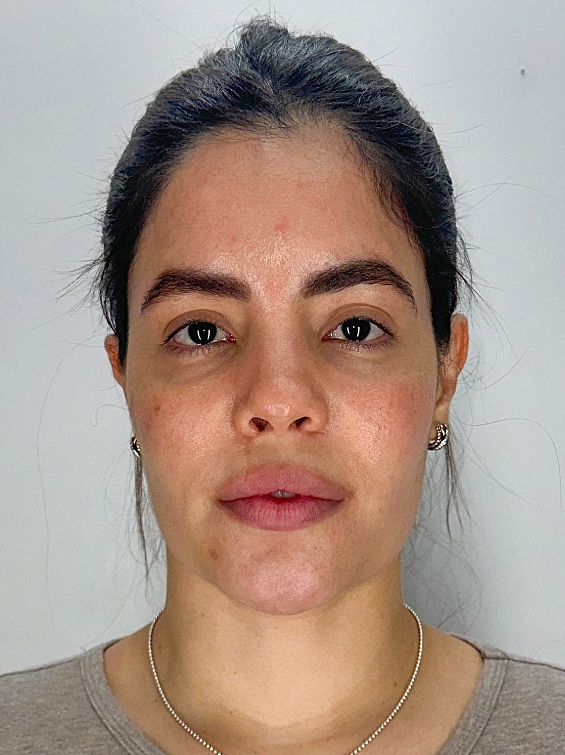 Facial Balancing Before & After