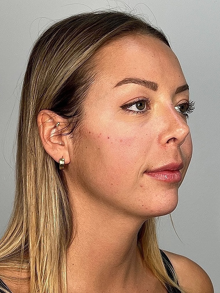 Facial Balancing Before & After