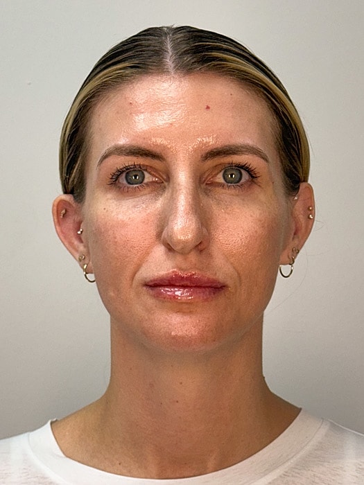 Facial Balancing Before & After
