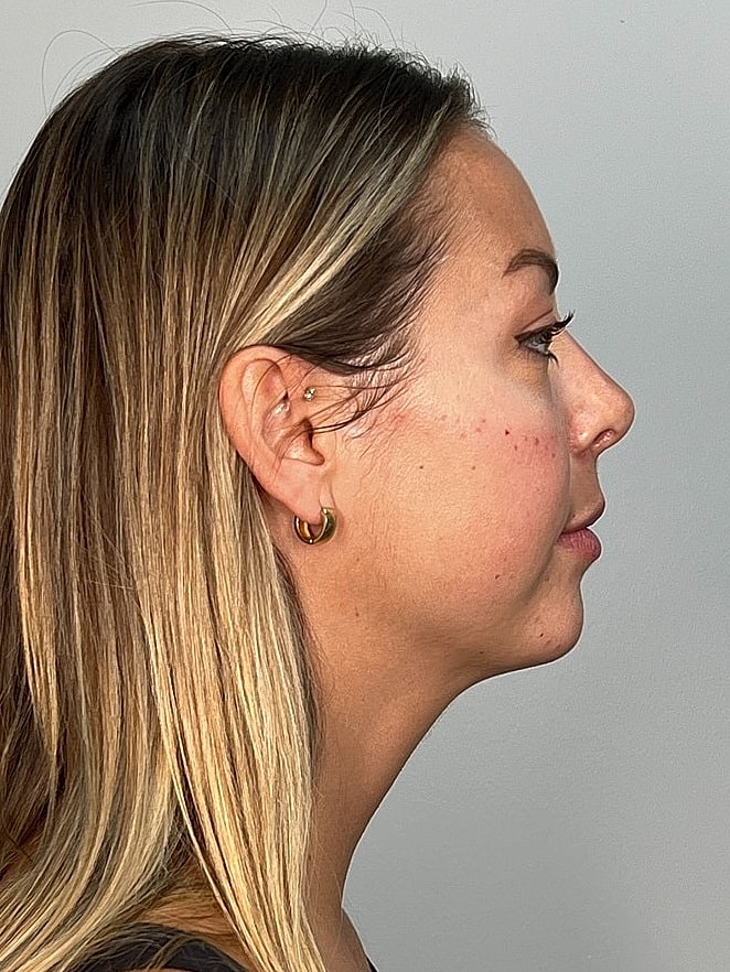 Facial Balancing Before & After