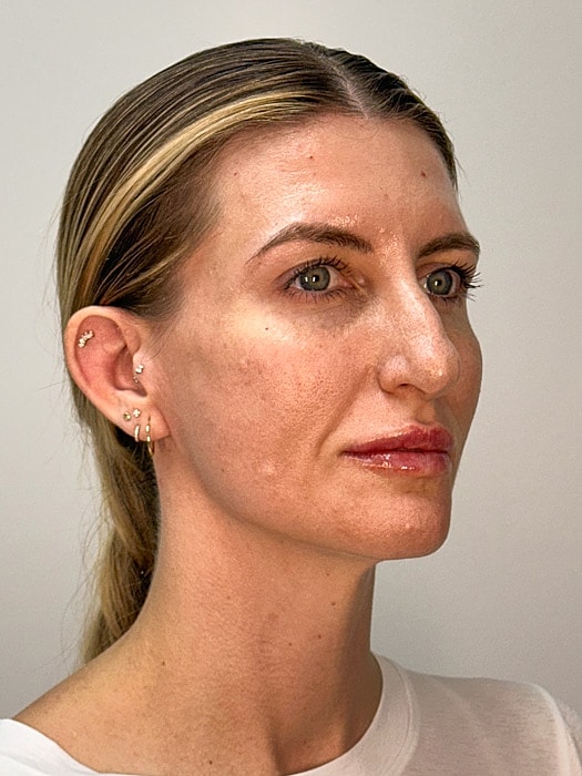 Facial Balancing Before & After