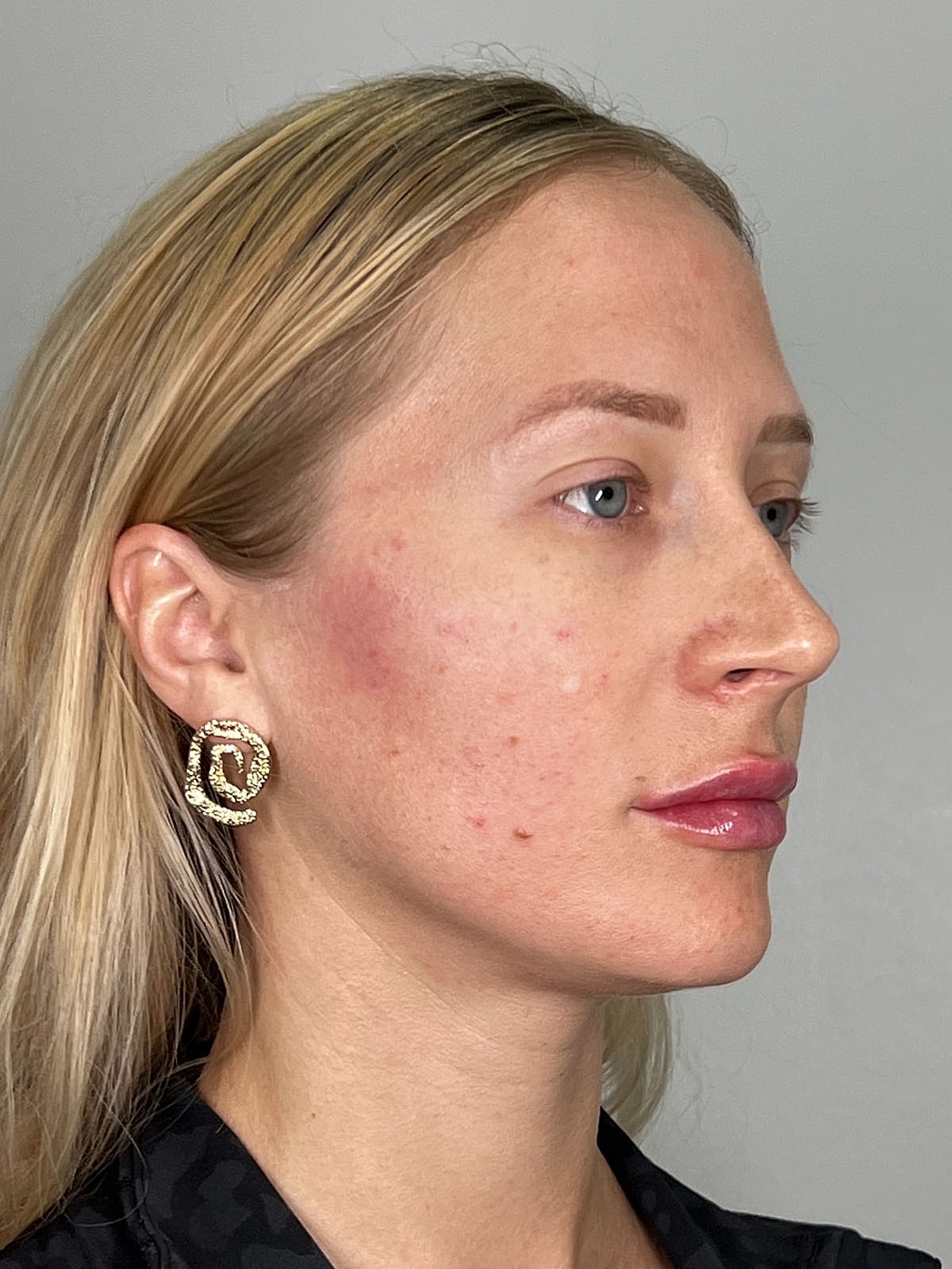 Facial Balancing Before & After