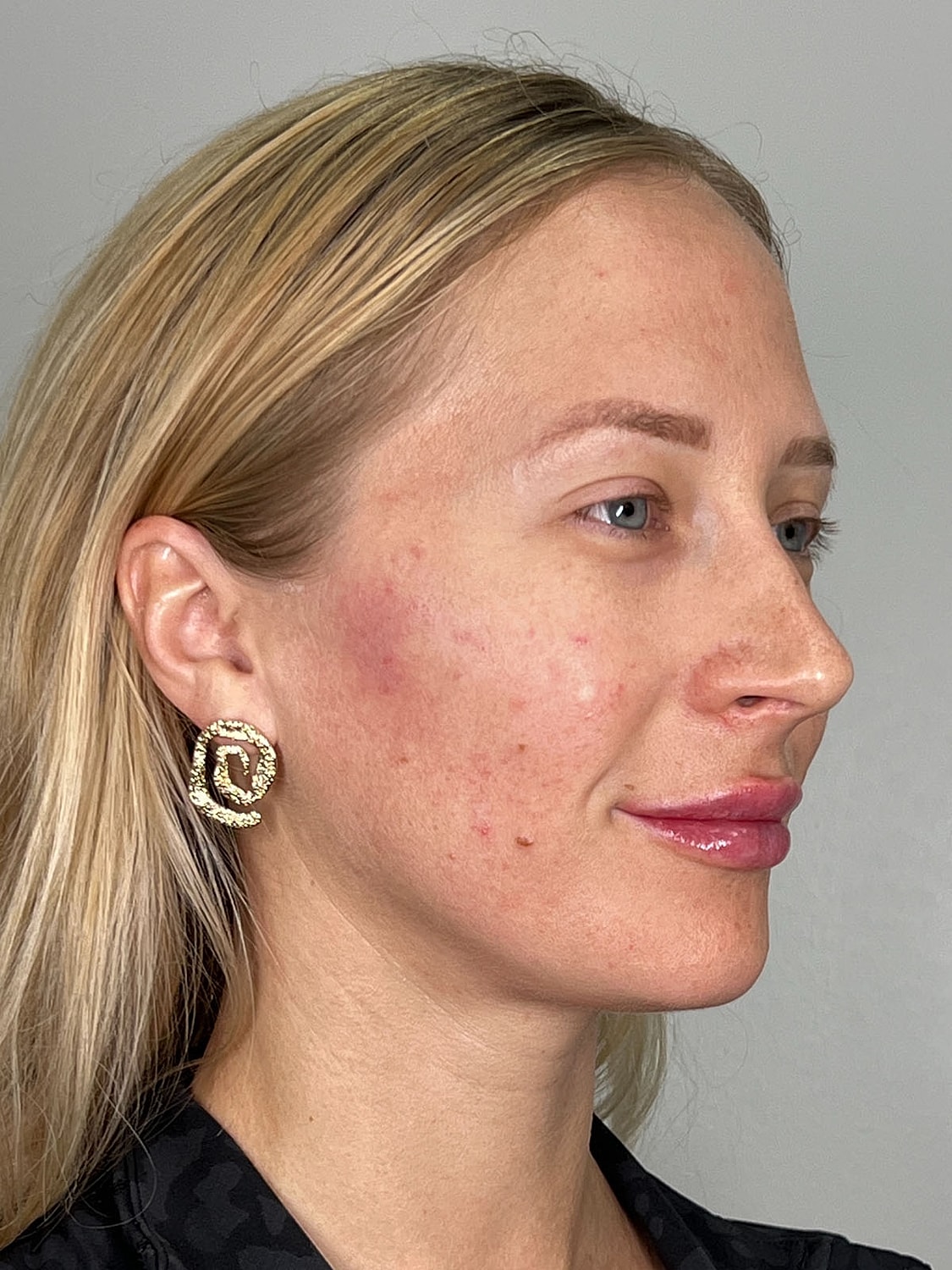 Facial Balancing Before & After