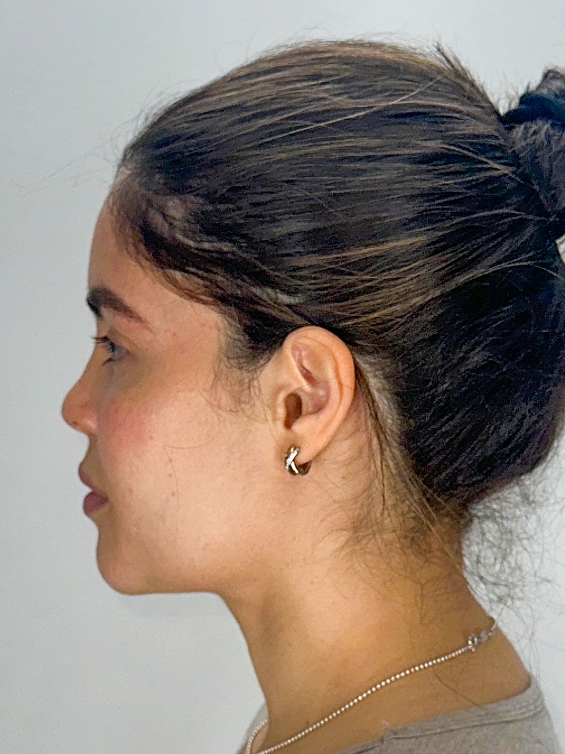 Facial Balancing Before & After