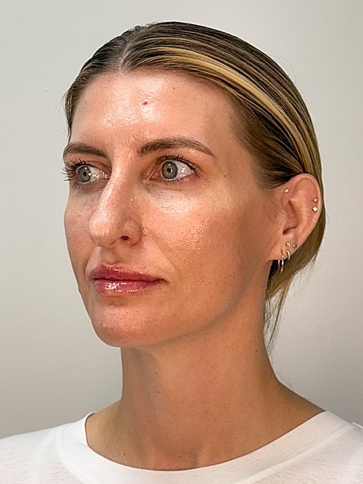 Facial Balancing Before & After