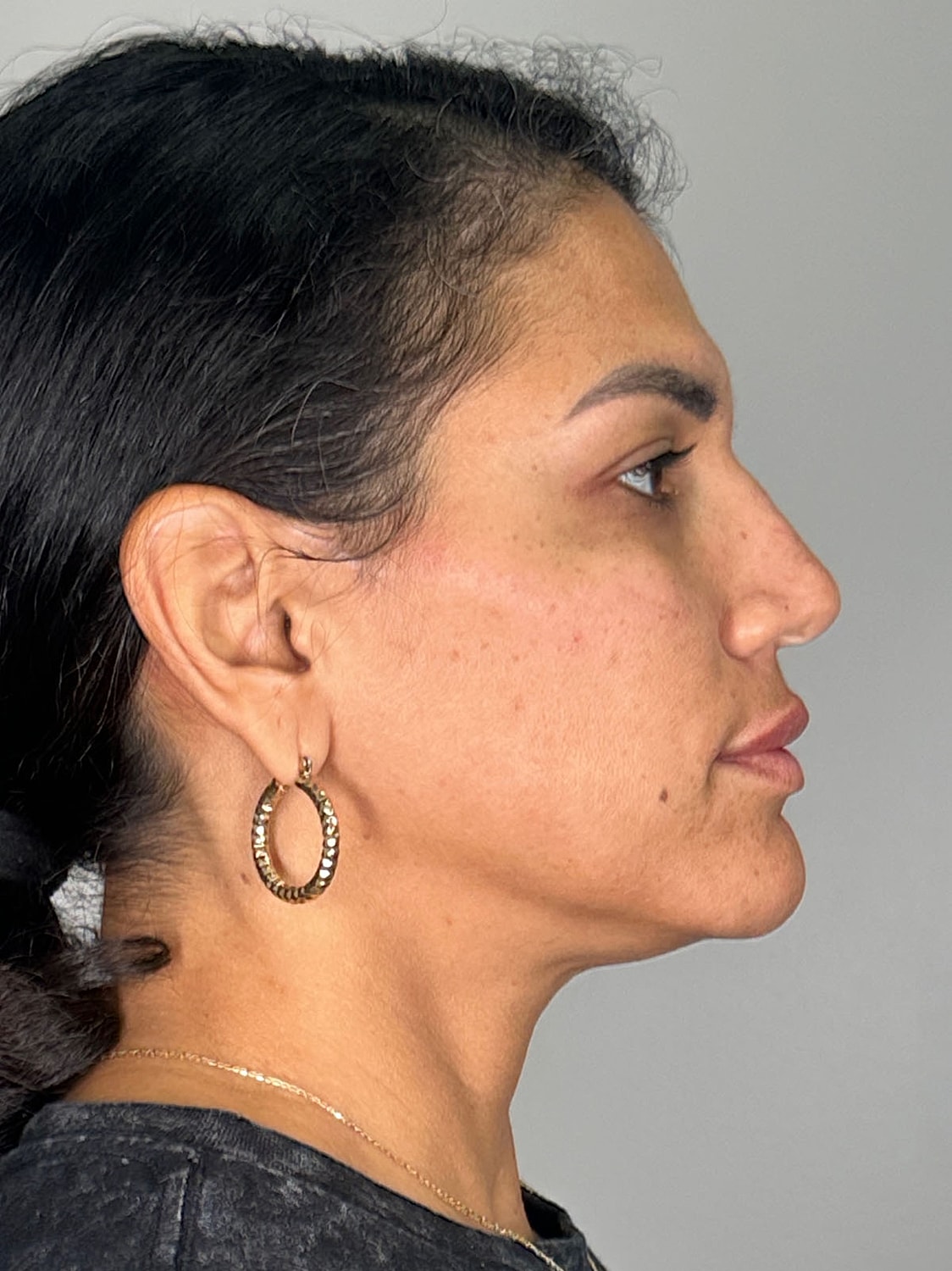 Facial Balancing Before & After