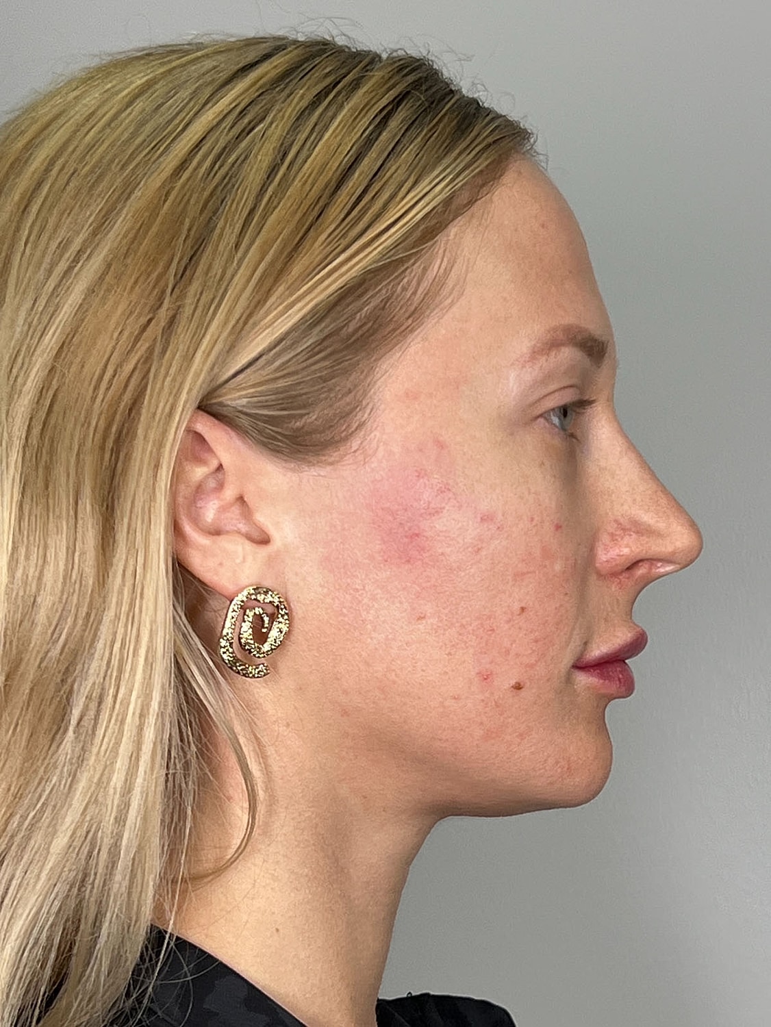 Facial Balancing Before & After