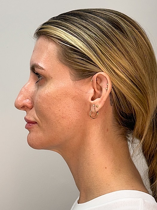 Facial Balancing Before & After
