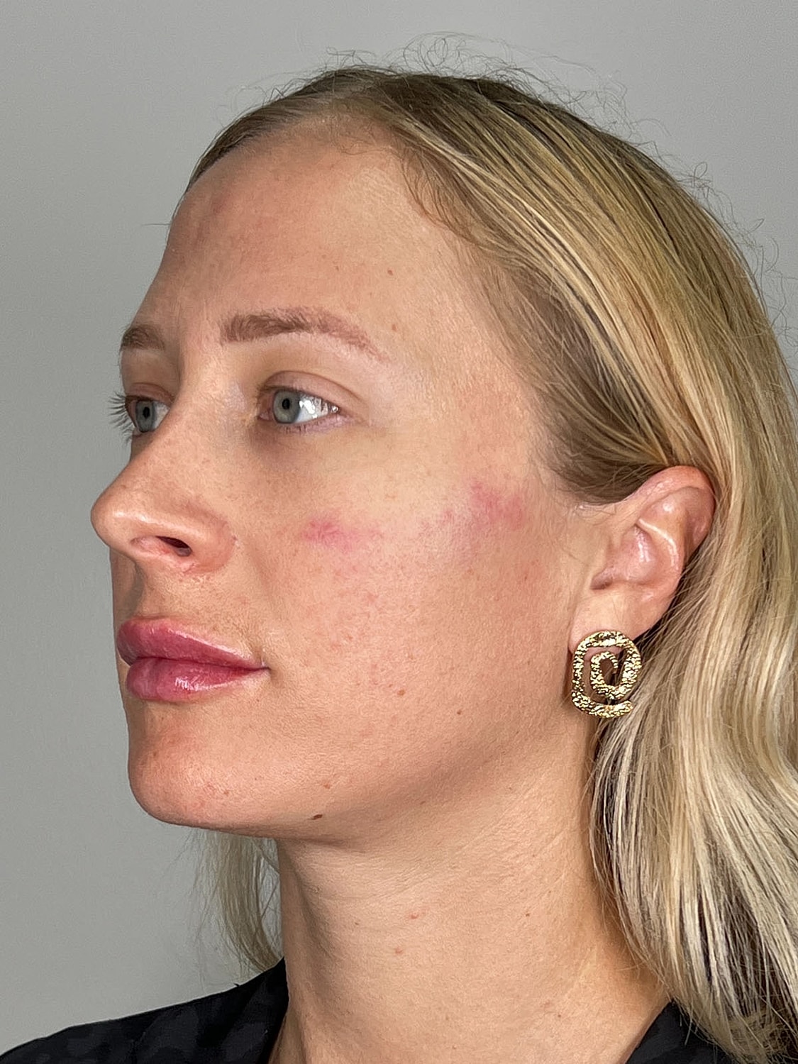 Facial Balancing Before & After