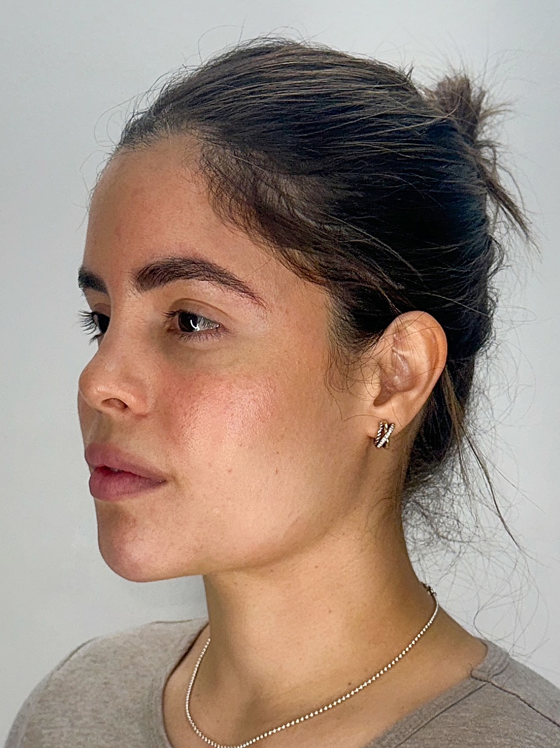 Facial Balancing Before & After