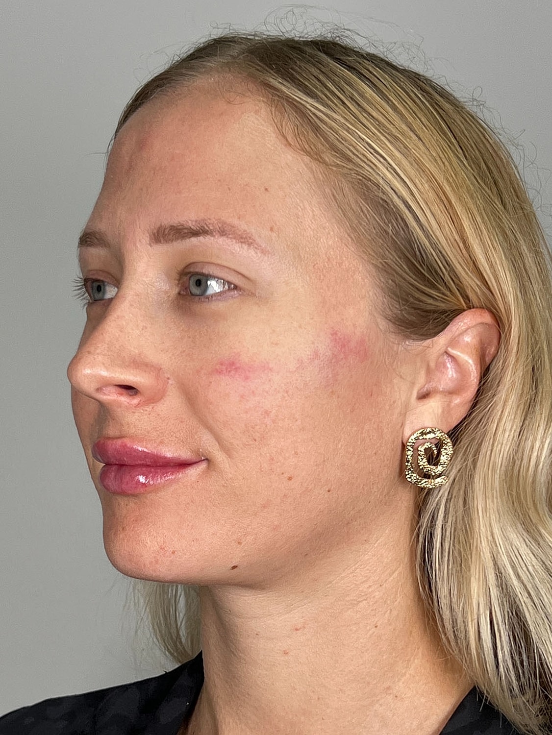 Facial Balancing Before & After