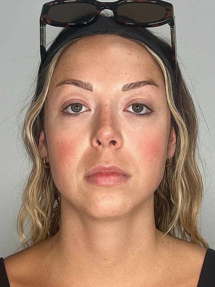 Facial Balancing Before & After