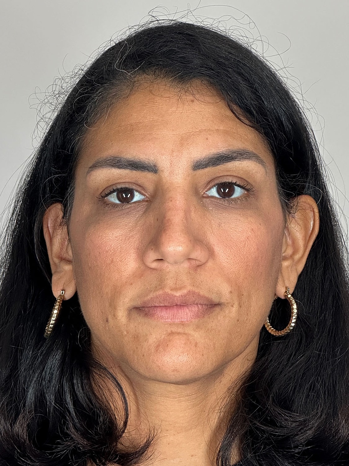 Facial Balancing Before & After