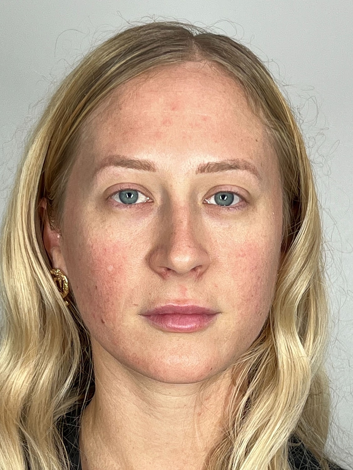 Facial Balancing Before & After