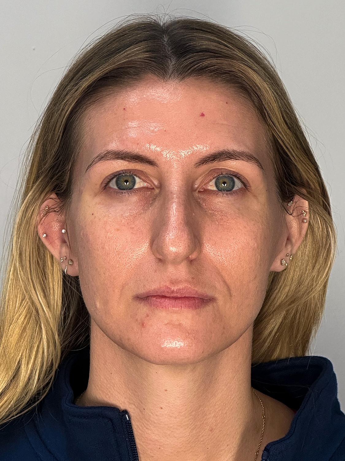 Facial Balancing Before & After