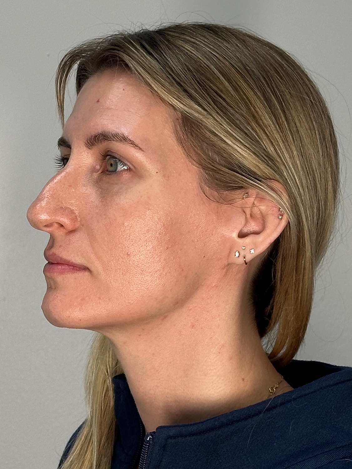 Facial Balancing Before & After