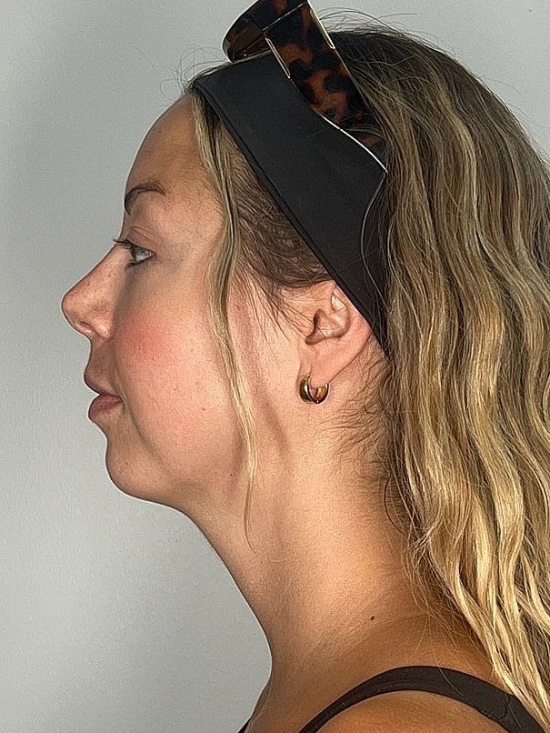Facial Balancing Before & After